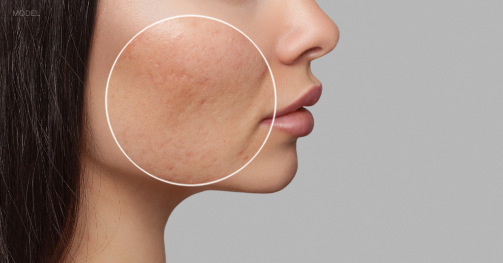 360° Acne Scar Treatments